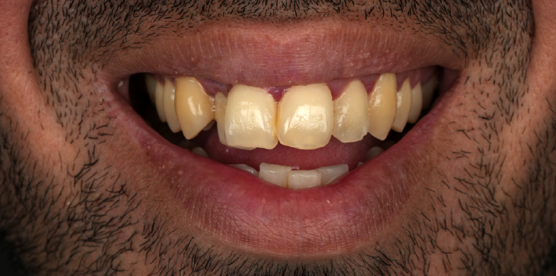 Close-up of a patient's natural teeth showing discoloration and uneven tooth appearance before restoration