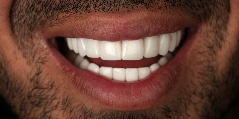Close-up of a patient's restored smile showing even tooth contours and improved cosmetic appearance