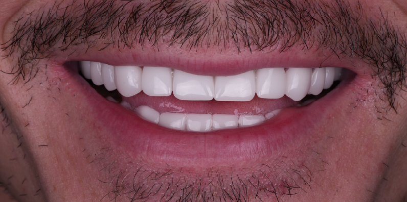 Close-up of a patient's brighter, more uniform smile following full-mouth restorative treatment