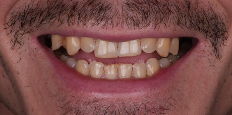 Close-up of a patient's upper and lower teeth showing their natural appearance before smile rehabilitation