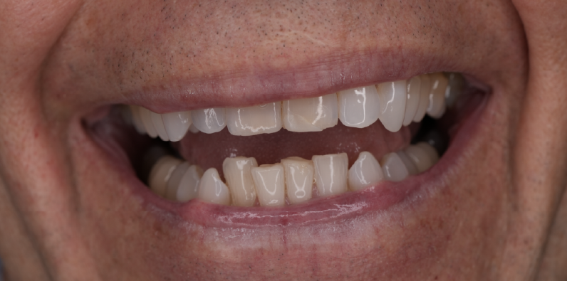 Close-up of a patient's natural teeth showing their appearance before full-mouth dental rehabilitation