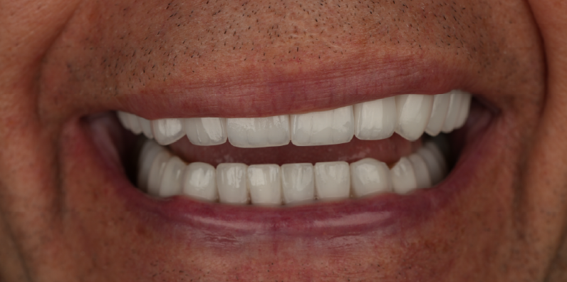 Close-up of a patient's smile showing evenly shaped teeth following full-mouth restorative dentistry