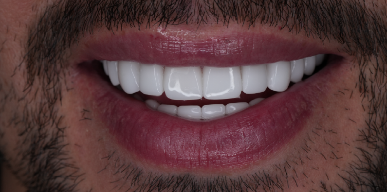Close-up of a patient's even, white teeth demonstrating the appearance of cosmetic dental restorations