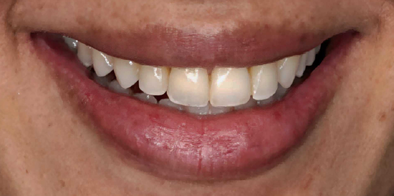 Close-up of a patient's teeth showing discoloration and irregular contours before cosmetic dental treatment