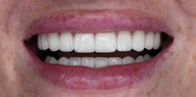 Close-up of a patient's white, evenly shaped teeth highlighting cosmetic smile design and symmetry