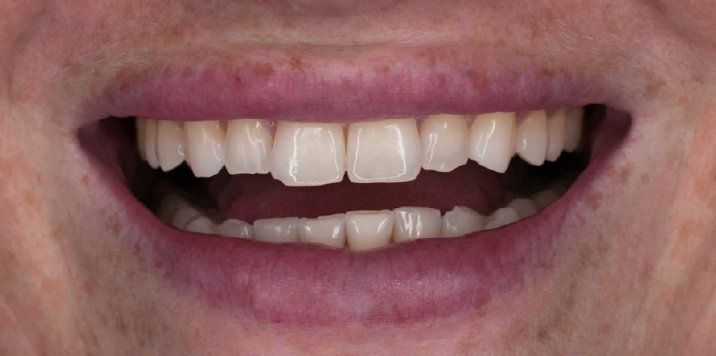 Close-up of a patient's upper and lower teeth showing their natural color and alignment