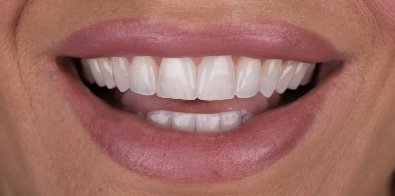 Close-up of a patient's natural-looking smile showing detailed tooth contours and even proportions