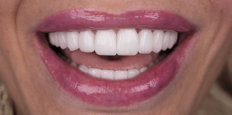 Close-up of a bright, symmetrical smile showcasing uniform tooth shape and cosmetic dental aesthetics