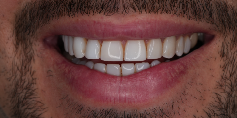 Close-up of a patient's upper and lower front teeth before porcelain smile enhancement