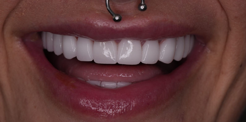 Close-up of a patient's bright upper teeth showing natural tooth contours and smile proportions