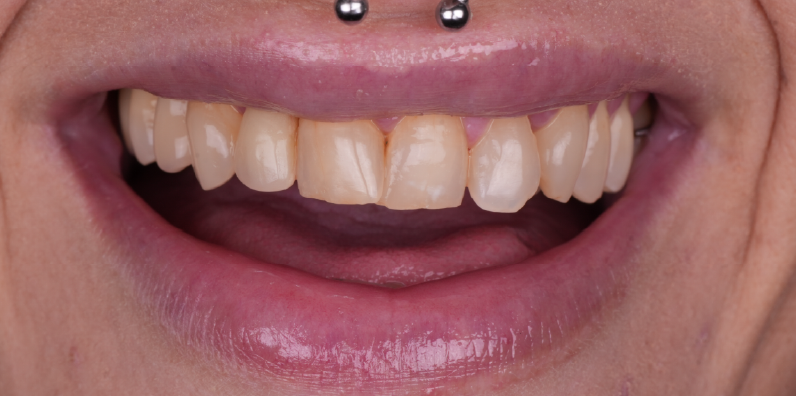 Close-up of a patient's smile showing tooth shape and color differences in a cosmetic dentistry comparison