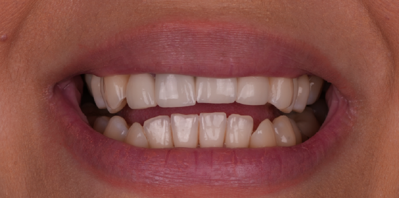 Close-up of natural upper and lower teeth before cosmetic smile enhancement with porcelain restorations
