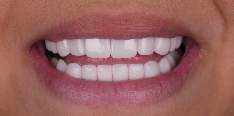 Close-up of a bright, symmetrical smile showcasing the appearance of porcelain dental restorations