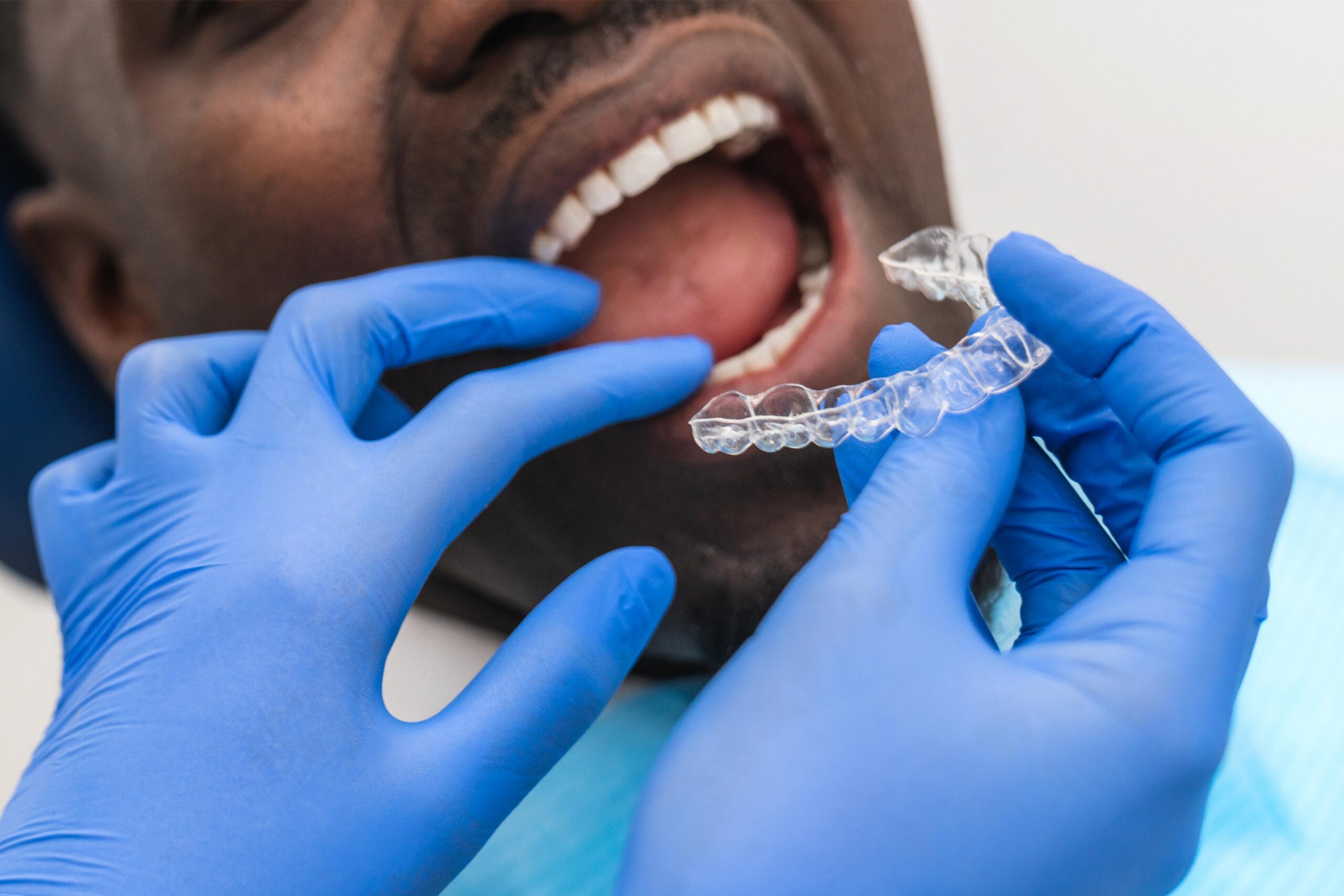 Dental professional wearing blue gloves positioning a clear orthodontic aligner near a patient's teeth