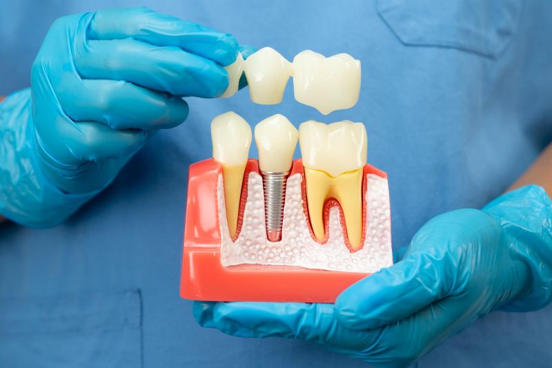 Dental model showing crowns and tooth root anatomy to illustrate restorative dentistry treatment