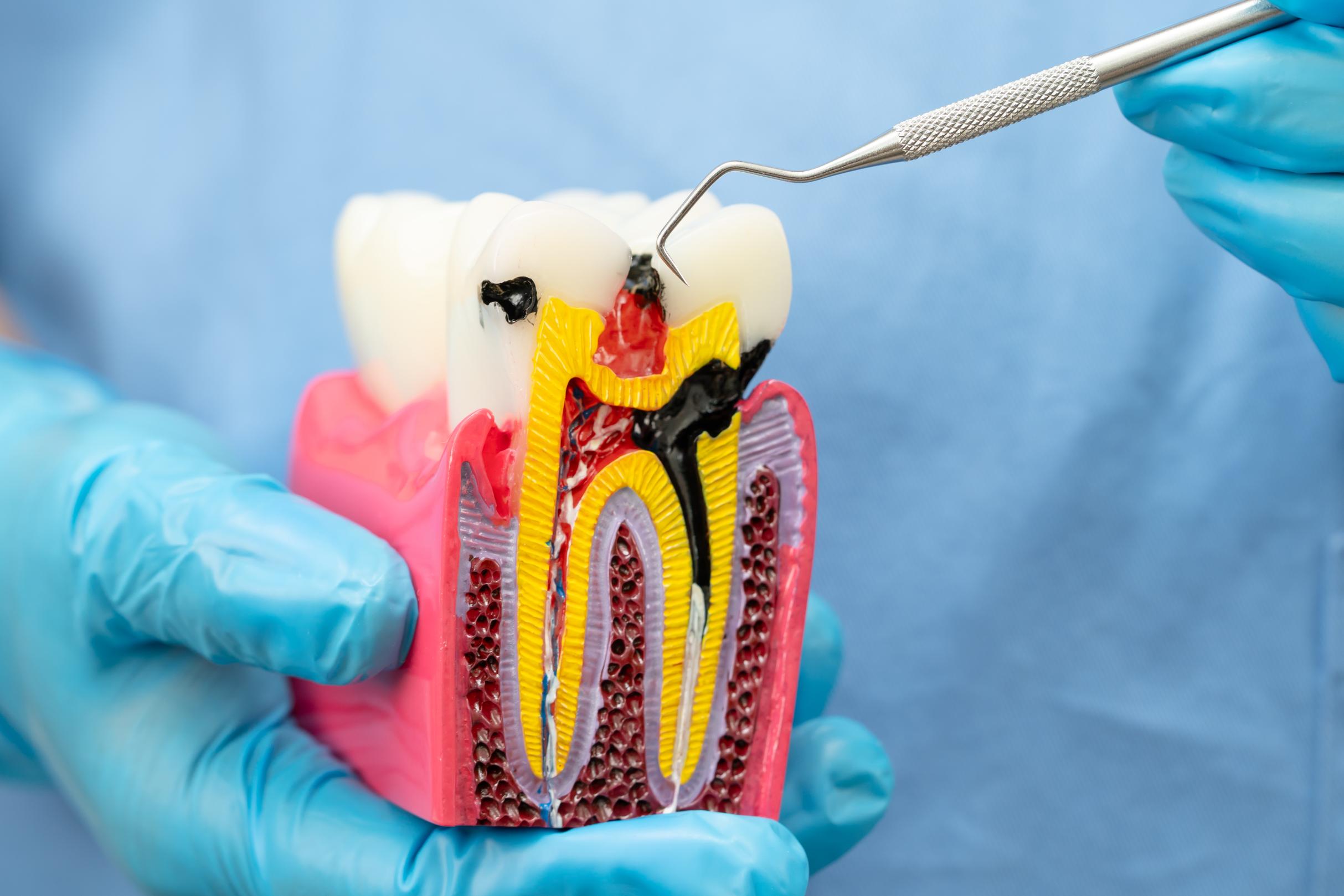 Dental decay model showing tooth roots, nerves, and instruments used to explain root canal treatment