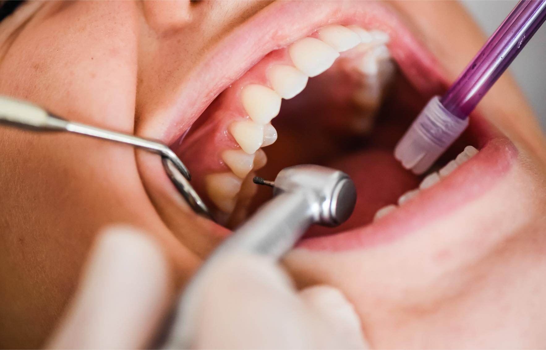 Close-up of a patient's mouth during a dental examination using a mirror and other dental instruments