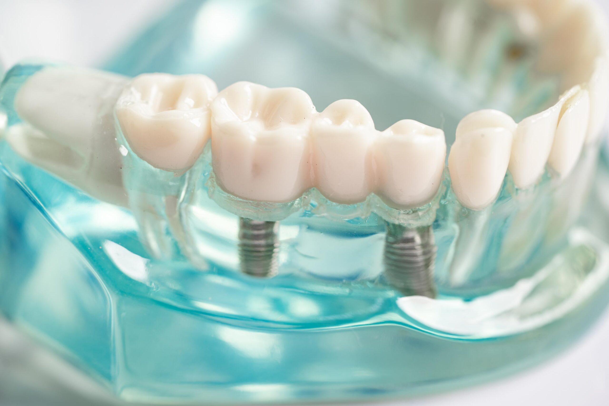 Close-up of a dental model showing a tooth replacement bridge supported by dental implants