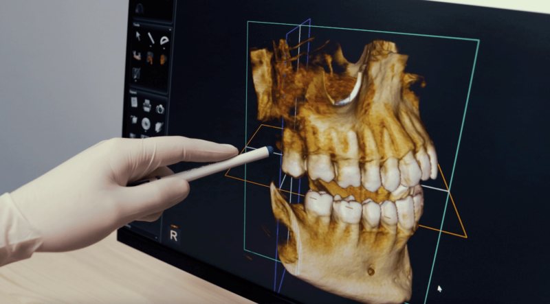 Three-dimensional CBCT scan displaying dental anatomy for implant planning and complex restorative procedures