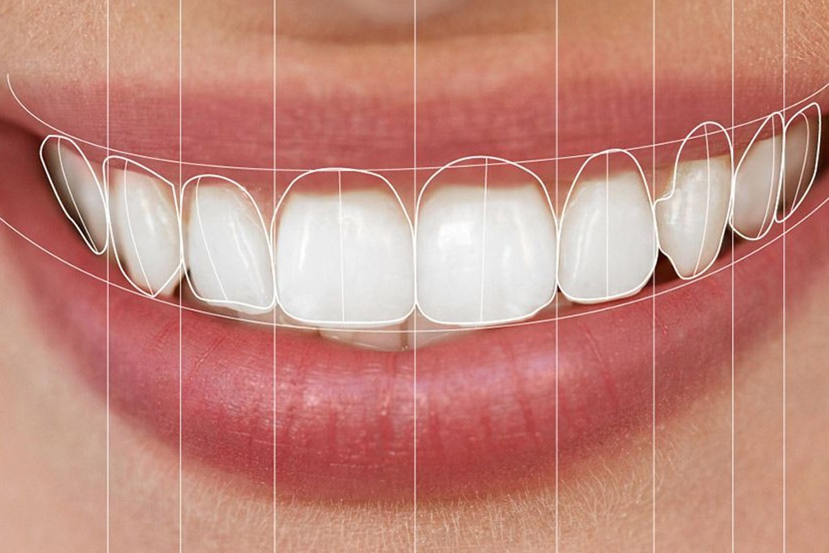 Illustration of porcelain veneers covering the front surfaces of teeth to improve their shape and appearance