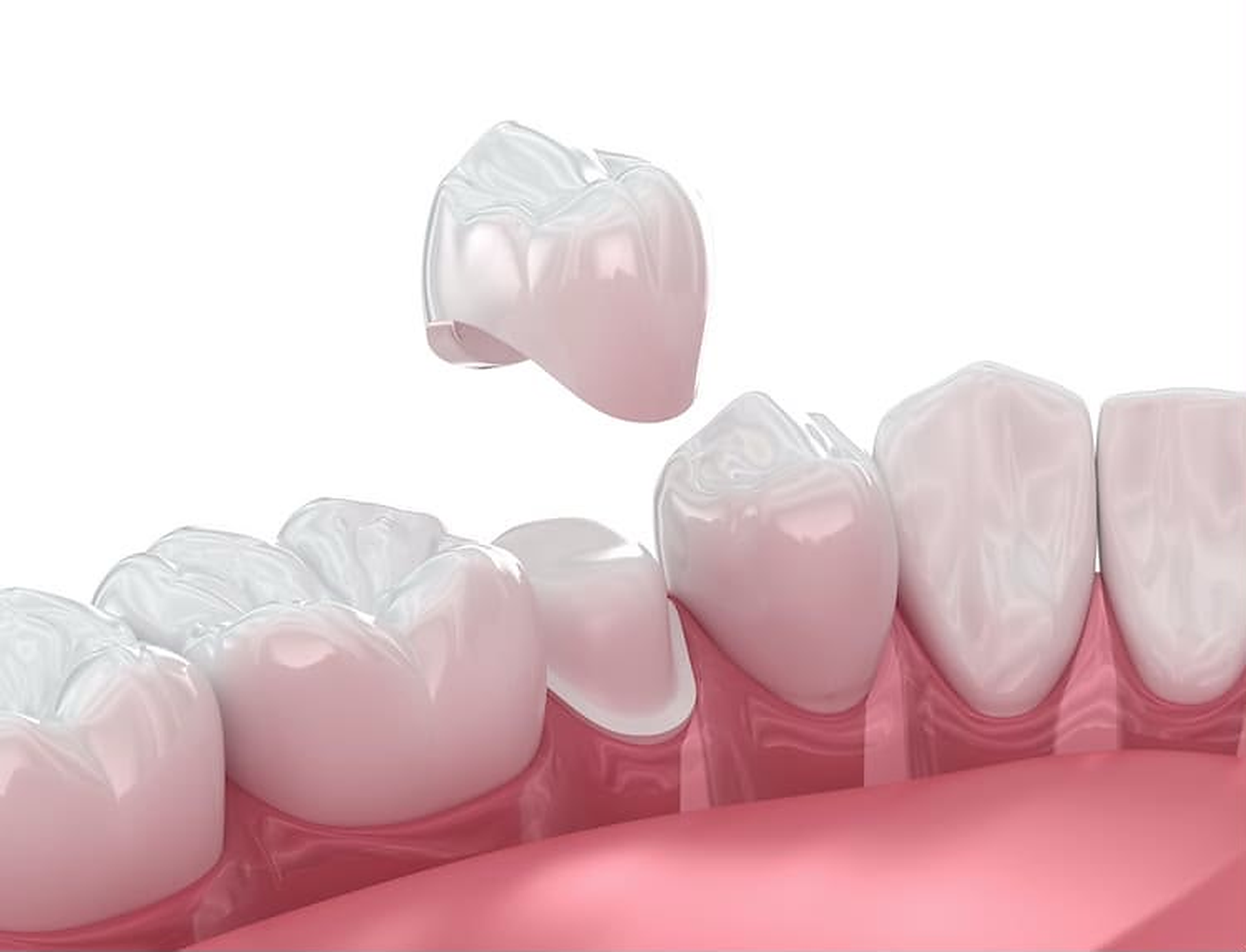 Tooth-colored ceramic dental crown restoration used to illustrate restorative dentistry treatment