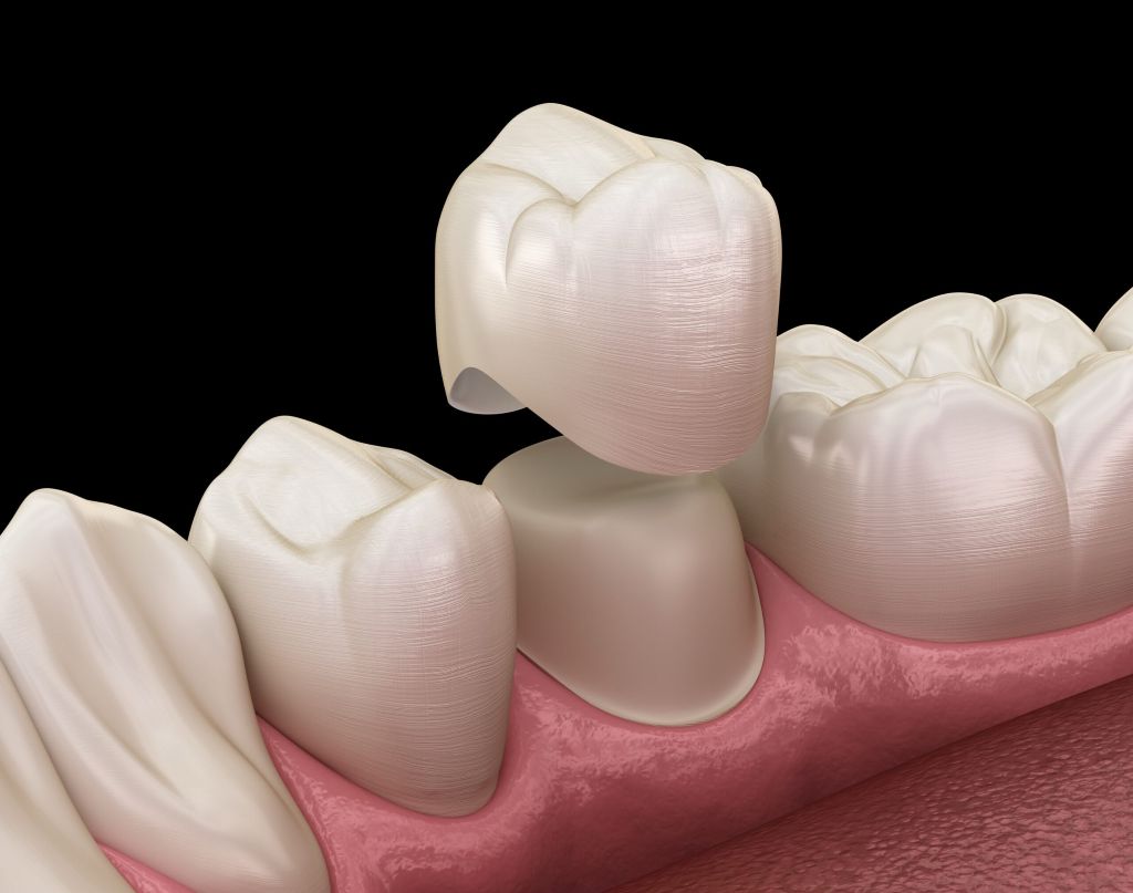 Close-up illustration of a dental crown restoring the appearance and function of a damaged tooth