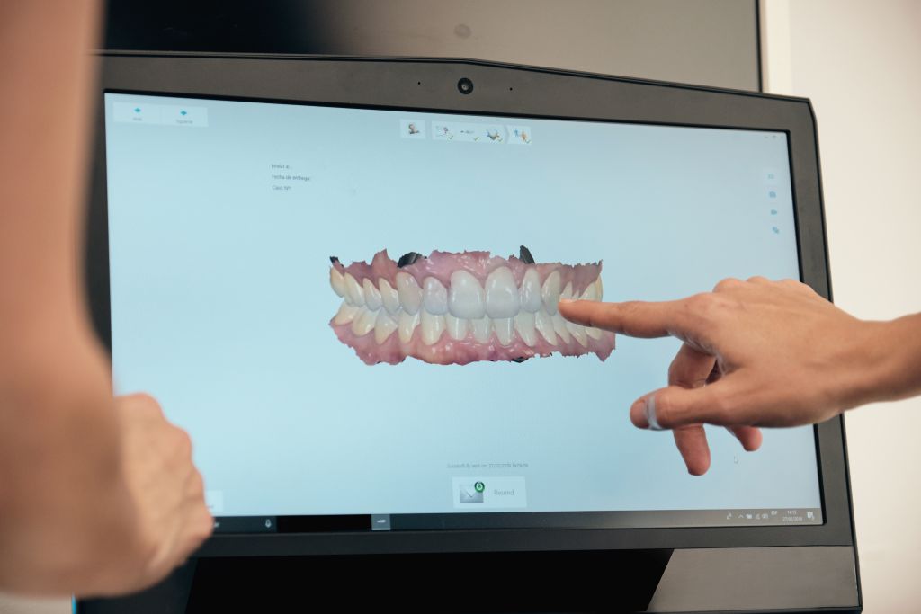 Digital smile design displayed on a computer monitor, showing a virtual model of teeth and bite alignment